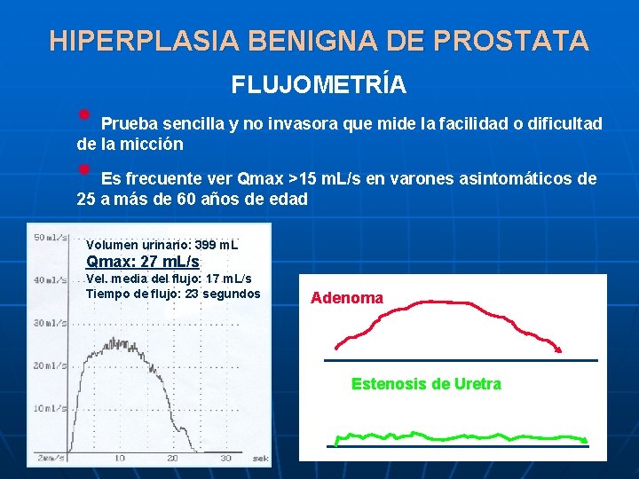 HIPERPLASIA BENIGNA DE PROSTATA • • FLUJOMETRÍA Prueba sencilla y no invasora que mide