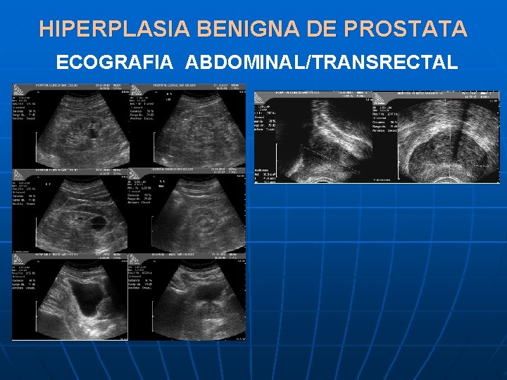 HIPERPLASIA BENIGNA DE PROSTATA ECOGRAFIA ABDOMINAL/TRANSRECTAL 