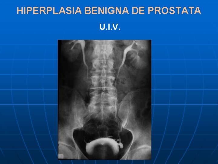 HIPERPLASIA BENIGNA DE PROSTATA U. I. V. 