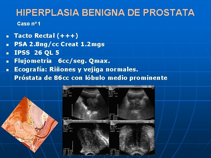 HIPERPLASIA BENIGNA DE PROSTATA Caso nº 1 n n n Tacto Rectal (+++) PSA