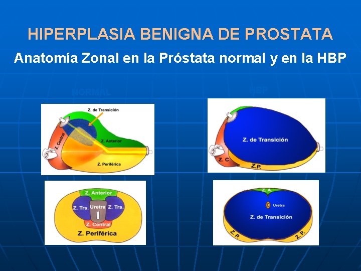 HIPERPLASIA BENIGNA DE PROSTATA Anatomía Zonal en la Próstata normal y en la HBP