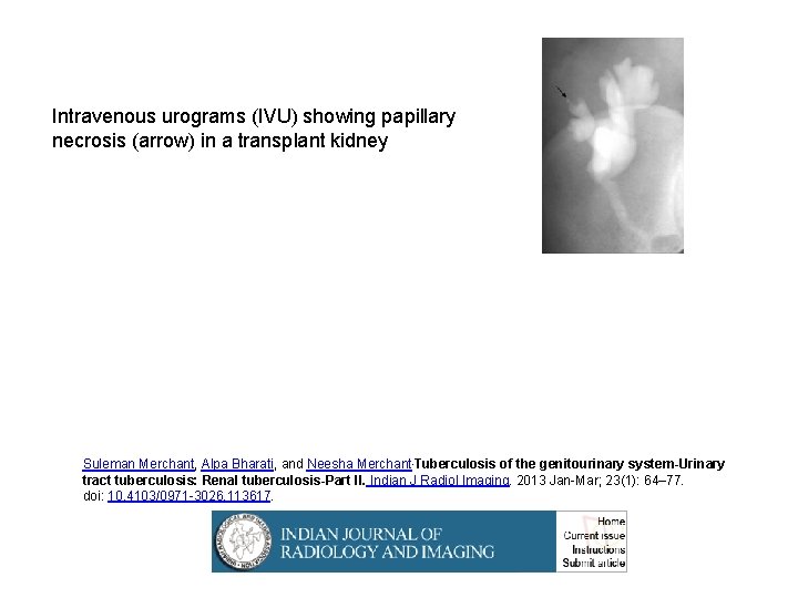 Intravenous urograms (IVU) showing papillary necrosis (arrow) in a transplant kidney Suleman Merchant, Alpa