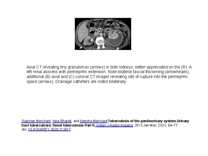 Axial CT revealing tiny granulomas (arrows) in both kidneys, better appreciated on the (R).