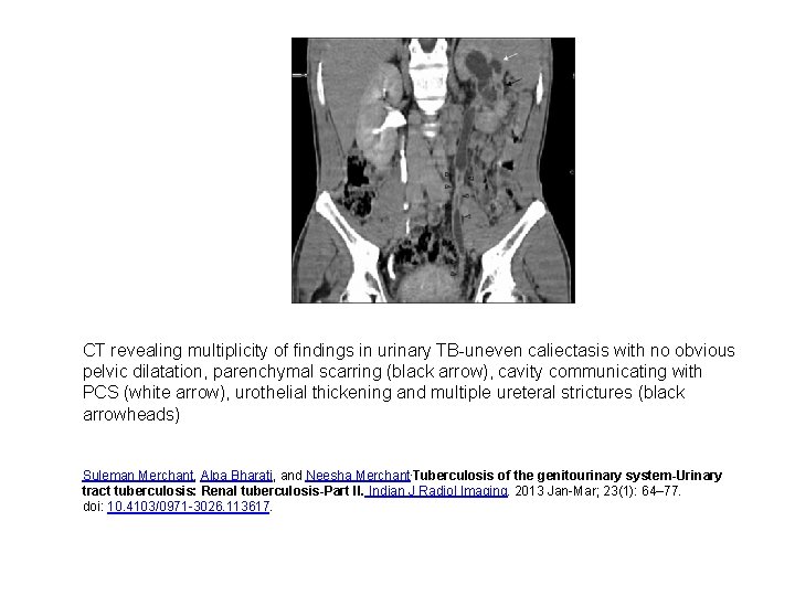 CT revealing multiplicity of findings in urinary TB-uneven caliectasis with no obvious pelvic dilatation,