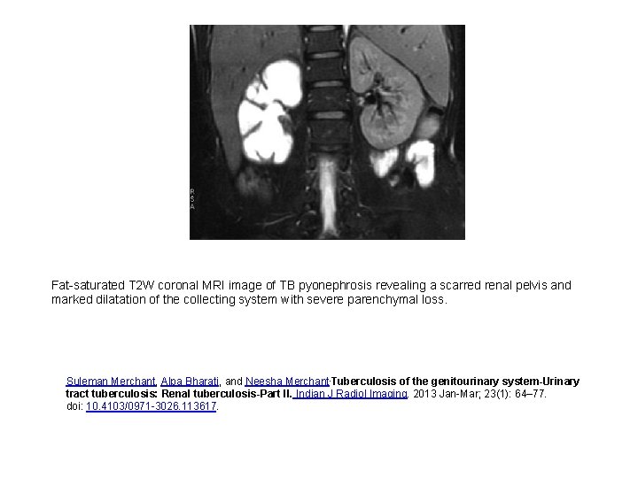 Fat-saturated T 2 W coronal MRI image of TB pyonephrosis revealing a scarred renal