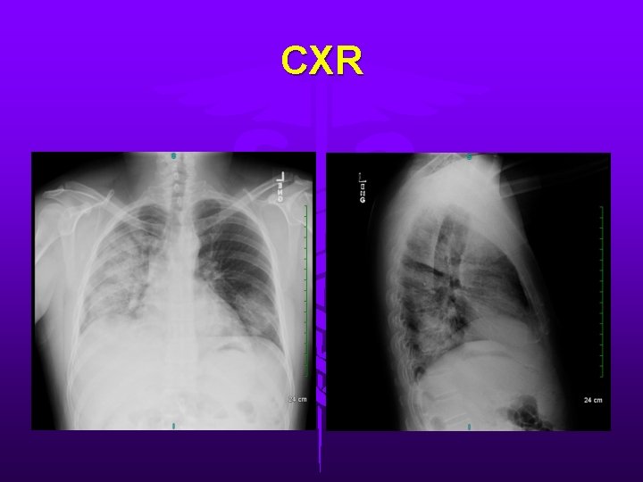 CXR 