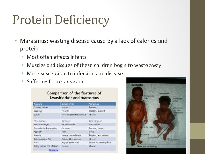 Protein Deficiency • Marasmus: wasting disease cause by a lack of calories and protein