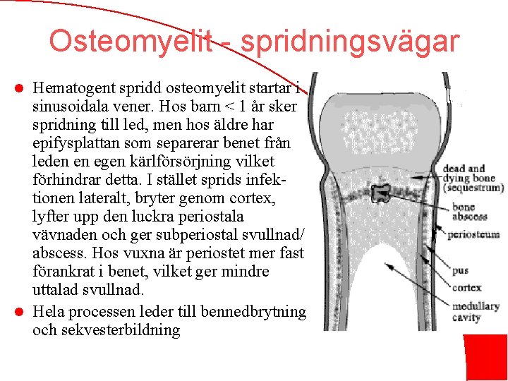 Osteomyelit - spridningsvägar Hematogent spridd osteomyelit startar i sinusoidala vener. Hos barn < 1
