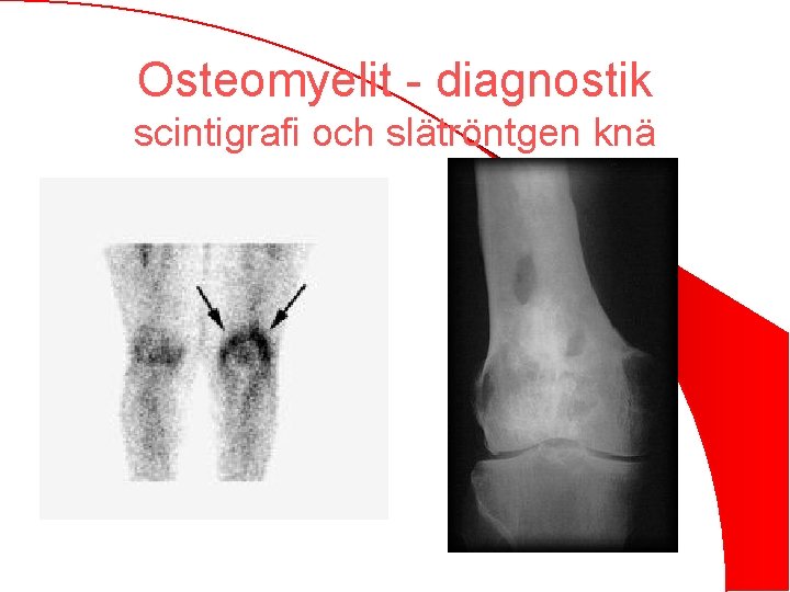 Osteomyelit - diagnostik scintigrafi och slätröntgen knä 