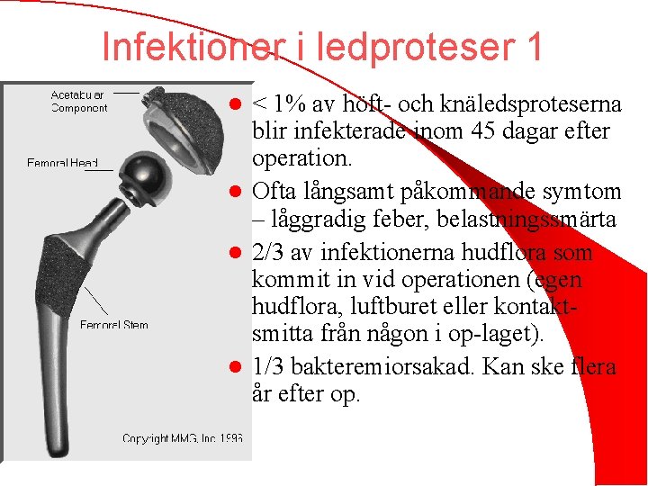 Infektioner i ledproteser 1 < 1% av höft- och knäledsproteserna blir infekterade inom 45
