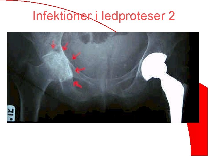 Infektioner i ledproteser 2 