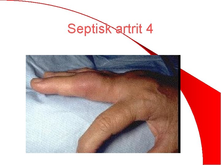 Septisk artrit 4 