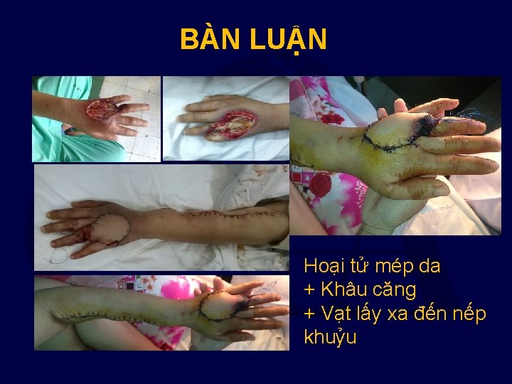 BÀN LUẬN Hoại tử mép da + Khâu căng + Vạt lấy xa đến