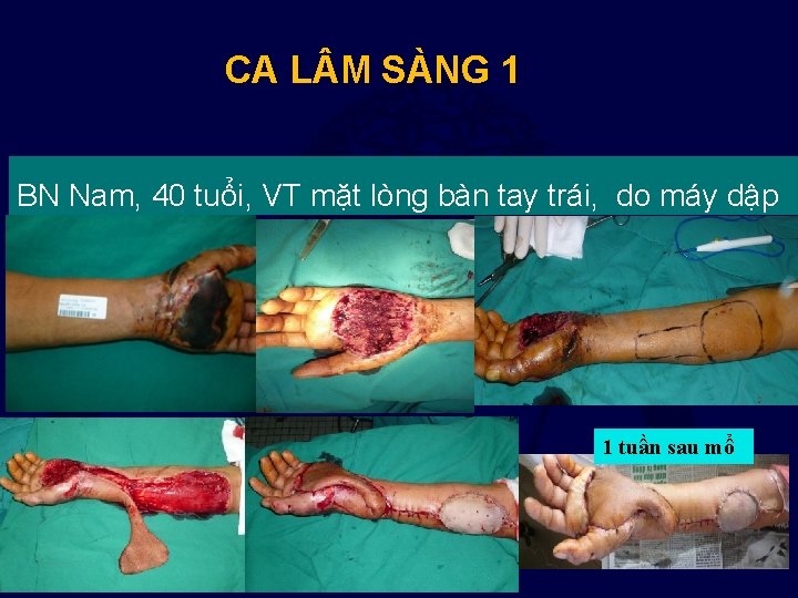 CA L M SÀNG 1 BN Nam, 40 tuổi, VT mặt lòng bàn tay