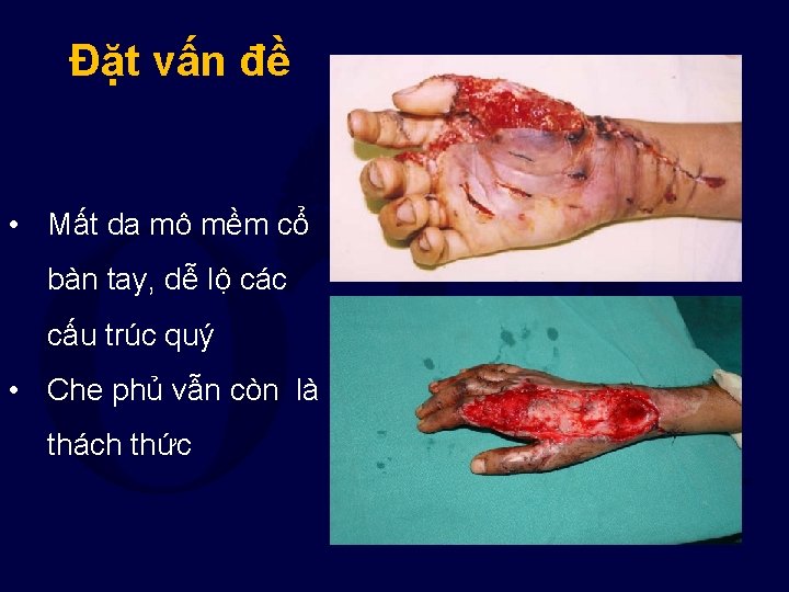 Đặt vấn đề • Mất da mô mềm cổ bàn tay, dễ lộ các