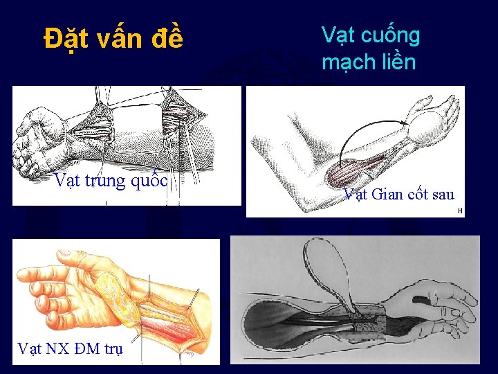 Đặt vấn đề Vạt trung quốc Vạt NX ĐM trụ Vạt cuống mạch liền