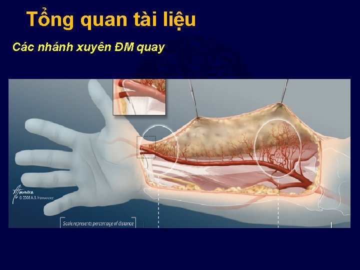 Tổng quan tài liệu Các nhánh xuyên ĐM quay 