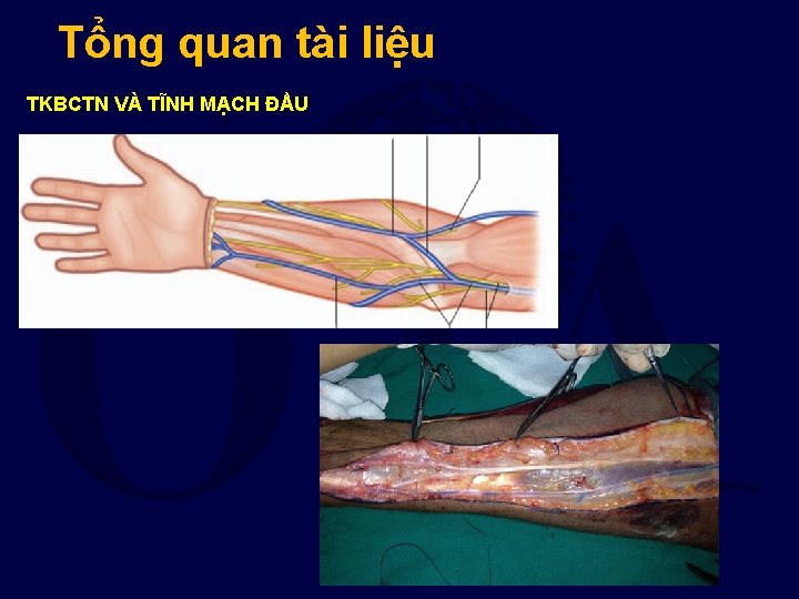 Tổng quan tài liệu TKBCTN VÀ TĨNH MẠCH ĐẦU 