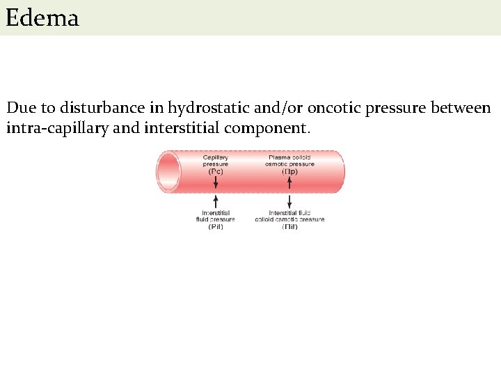 Edema Due to disturbance in hydrostatic and/or oncotic pressure between intra-capillary and interstitial component.
