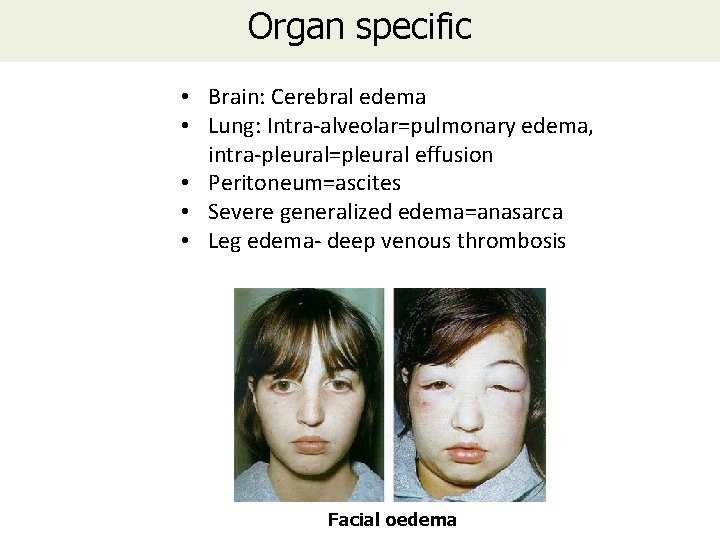 Organ specific • Brain: Cerebral edema • Lung: Intra-alveolar=pulmonary edema, intra-pleural=pleural effusion • Peritoneum=ascites