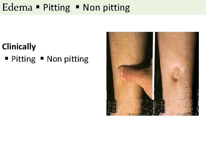 Edema▪Pitting ▪Non pitting Clinically ▪Pitting ▪Non pitting 