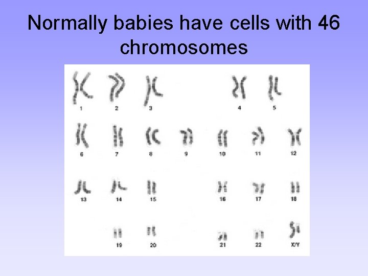 Normally babies have cells with 46 chromosomes 