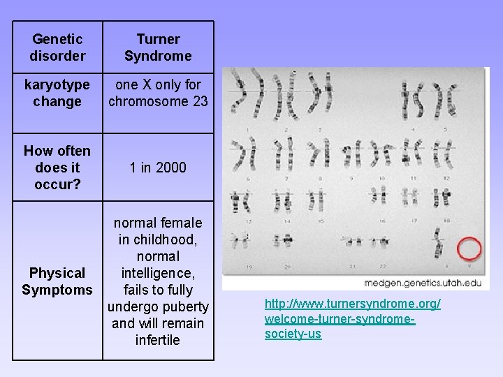 Genetic disorder Turner Syndrome karyotype change one X only for chromosome 23 How often