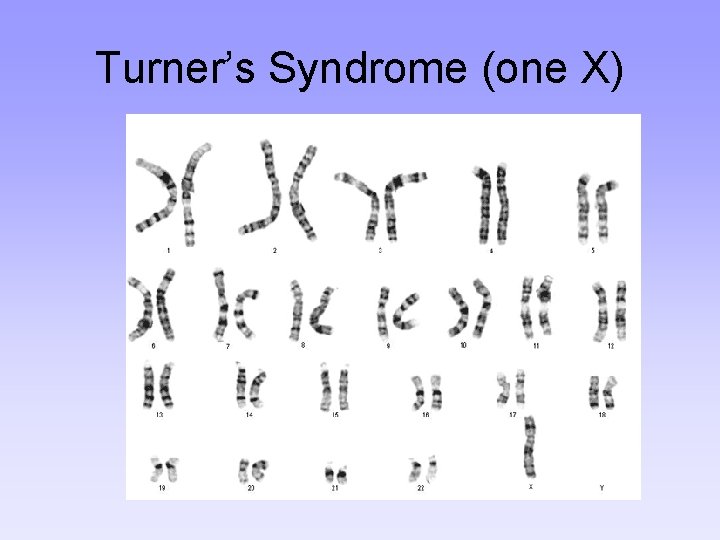 Turner’s Syndrome (one X) 