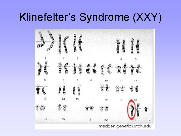 Klinefelter’s Syndrome (XXY) 