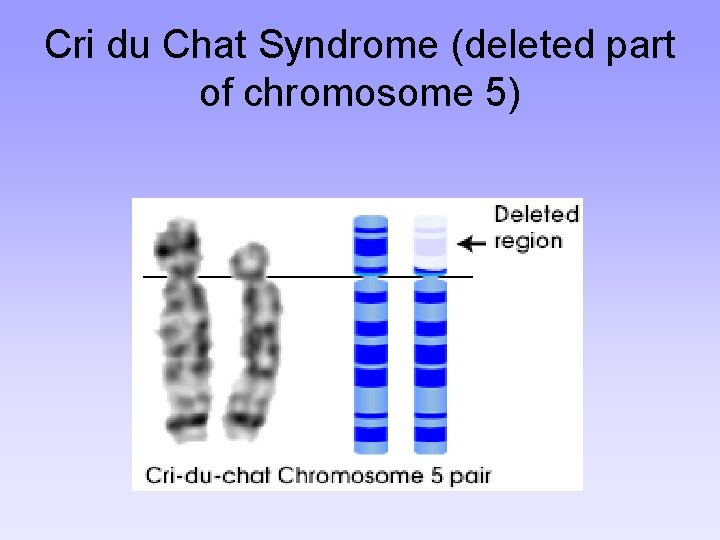 Cri du Chat Syndrome (deleted part of chromosome 5) 