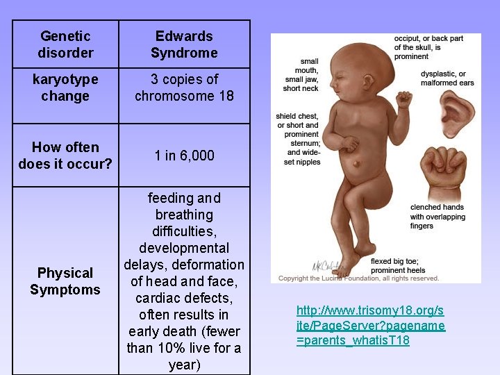 Genetic disorder Edwards Syndrome karyotype change 3 copies of chromosome 18 How often does