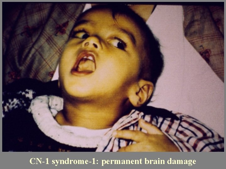 CN-1 syndrome-1: permanent brain damage 