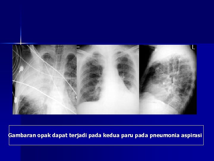 Gambaran opak dapat terjadi pada kedua paru pada pneumonia aspirasi 