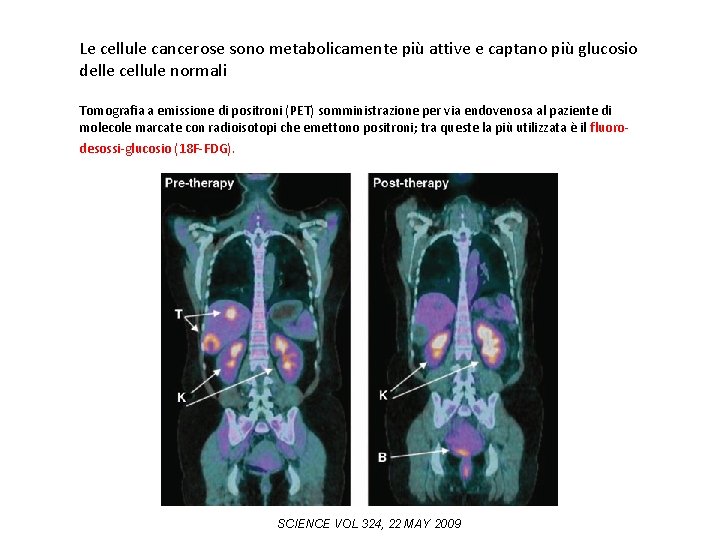 Le cellule cancerose sono metabolicamente più attive e captano più glucosio delle cellule normali