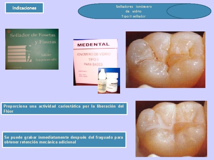Indicaciones Selladores Ionómero de vidrio Tipo II sellador Proporciona una actividad cariostática por la