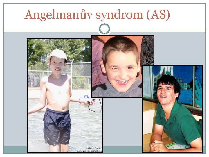 Angelmanův syndrom (AS) 