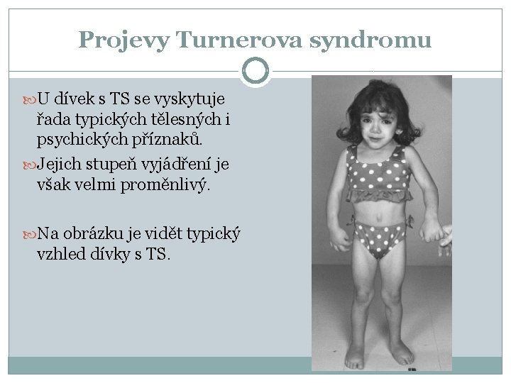 Projevy Turnerova syndromu U dívek s TS se vyskytuje řada typických tělesných i psychických