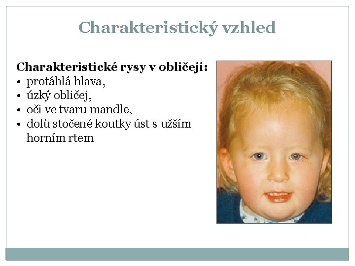 Charakteristický vzhled Charakteristické rysy v obličeji: • protáhlá hlava, • úzký obličej, • oči