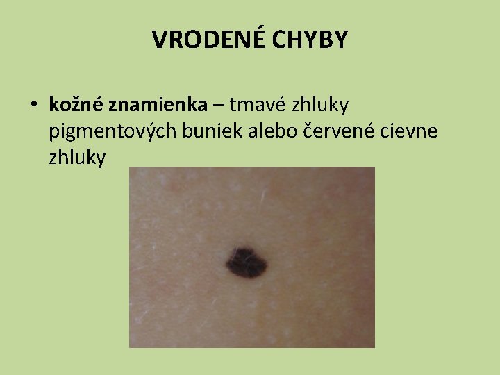 VRODENÉ CHYBY • kožné znamienka – tmavé zhluky pigmentových buniek alebo červené cievne zhluky