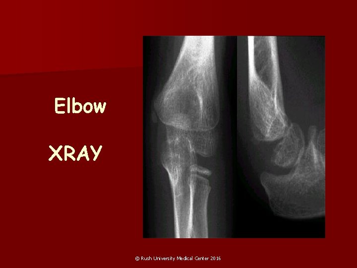 Elbow XRAY © Rush University Medical Center 2016 