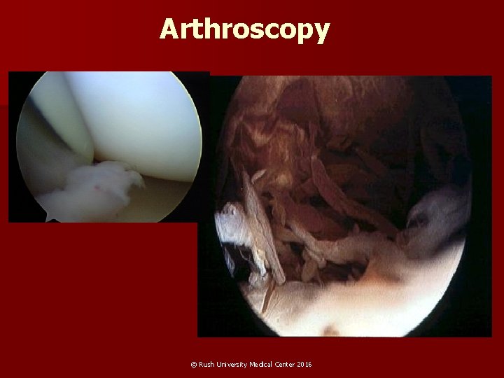 Arthroscopy © Rush University Medical Center 2016 