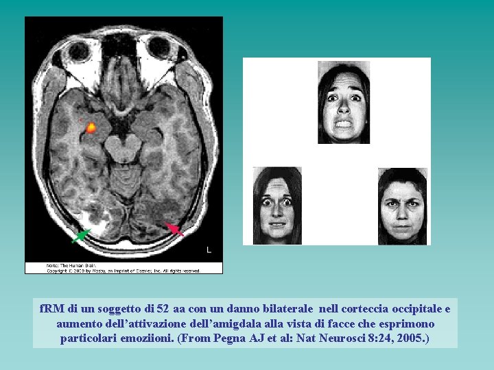 f. RM di un soggetto di 52 aa con un danno bilaterale nell corteccia