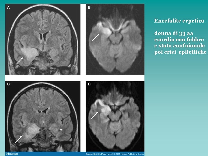 Encefalite erpetica donna di 33 aa esordio con febbre e stato confuionale poi crisi