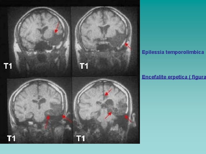 Epilessia temporolimbica Encefalite erpetica ( figura 