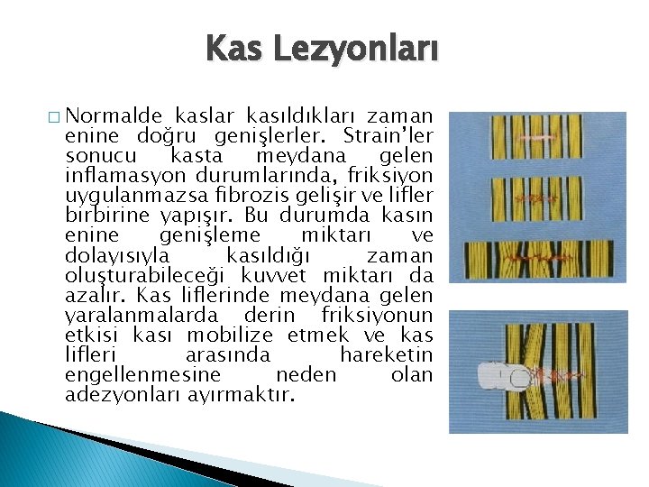 Kas Lezyonları � Normalde kaslar kasıldıkları zaman enine doğru genişlerler. Strain’ler sonucu kasta meydana