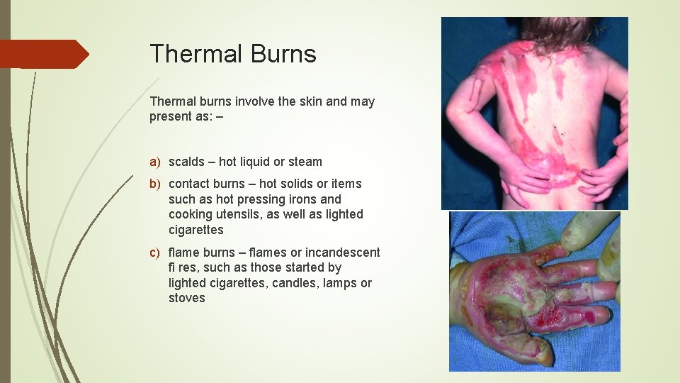 Thermal Burns Thermal burns involve the skin and may present as: – a) scalds