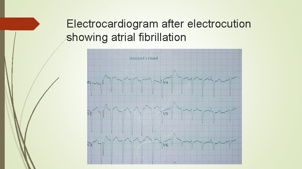 Electrocardiogram after electrocution showing atrial fibrillation 