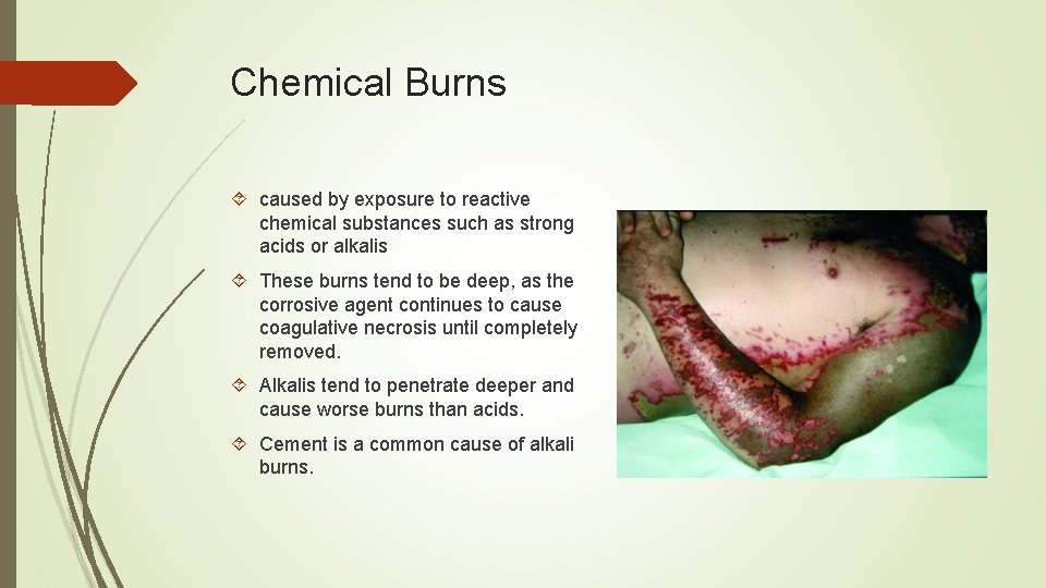 Chemical Burns caused by exposure to reactive chemical substances such as strong acids or