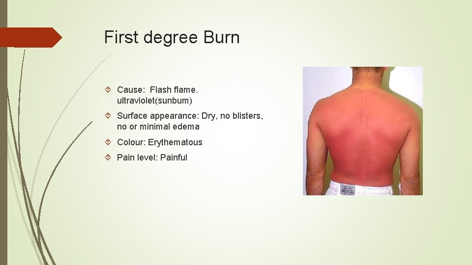 First degree Burn Cause: Flash flame. ultraviolet(sunbum) Surface appearance: Dry, no blisters, no or