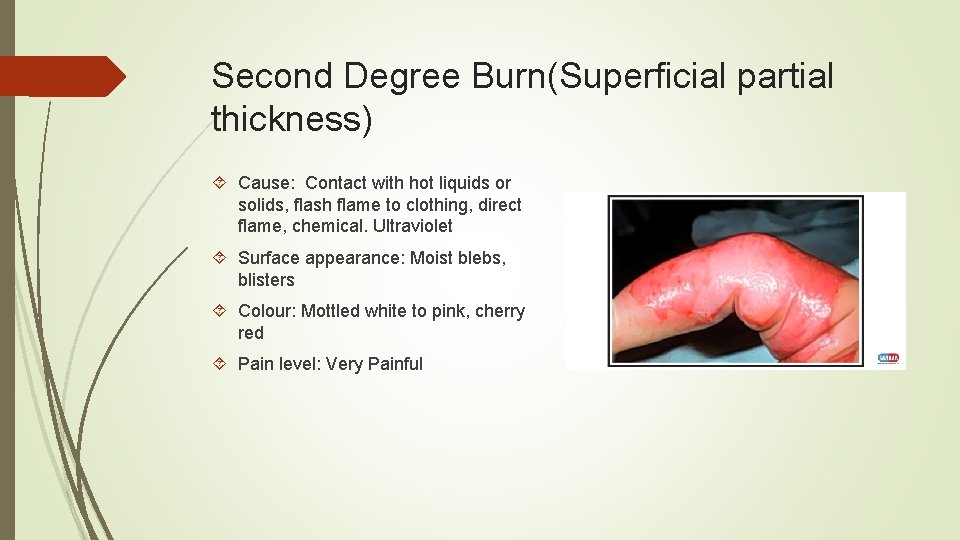 Second Degree Burn(Superficial partial thickness) Cause: Contact with hot liquids or solids, flash flame